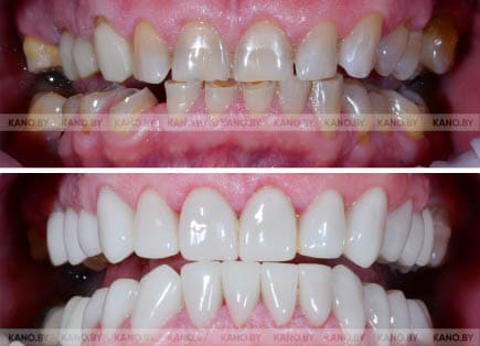 Ц.С. Кейс №2. Тотальное протезирование коронками Emax на импланты и зубы