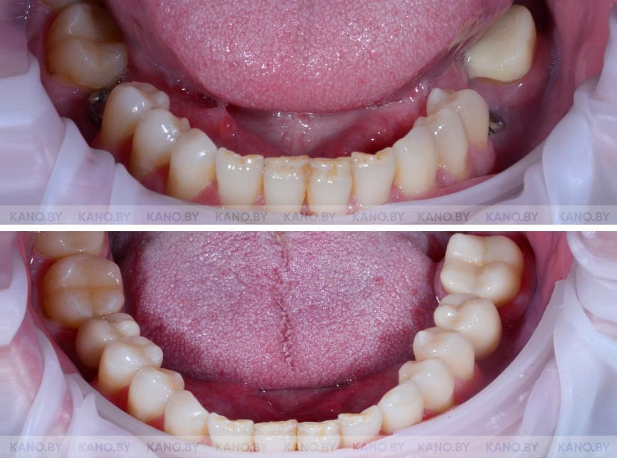 Ц.С. Кейс №40. Циркониевые коронки для восстановления боковых зубов