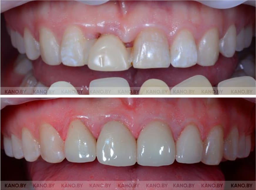 Ц.С. Кейс №45. Реставрация передних зубов коронками E.max