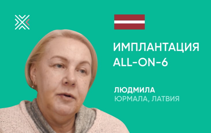 Отзыв на комплексную имплантацию по технологии All-on-6 в Минске, клиника KANO