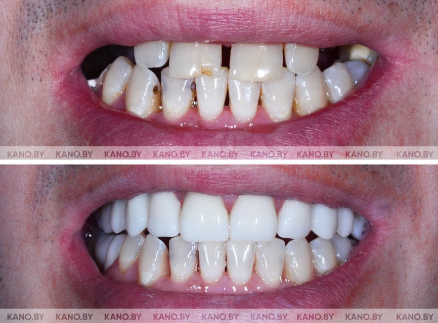 Ц.С. Кейс №36. Восстановление зубов коронками из диоксида циркония