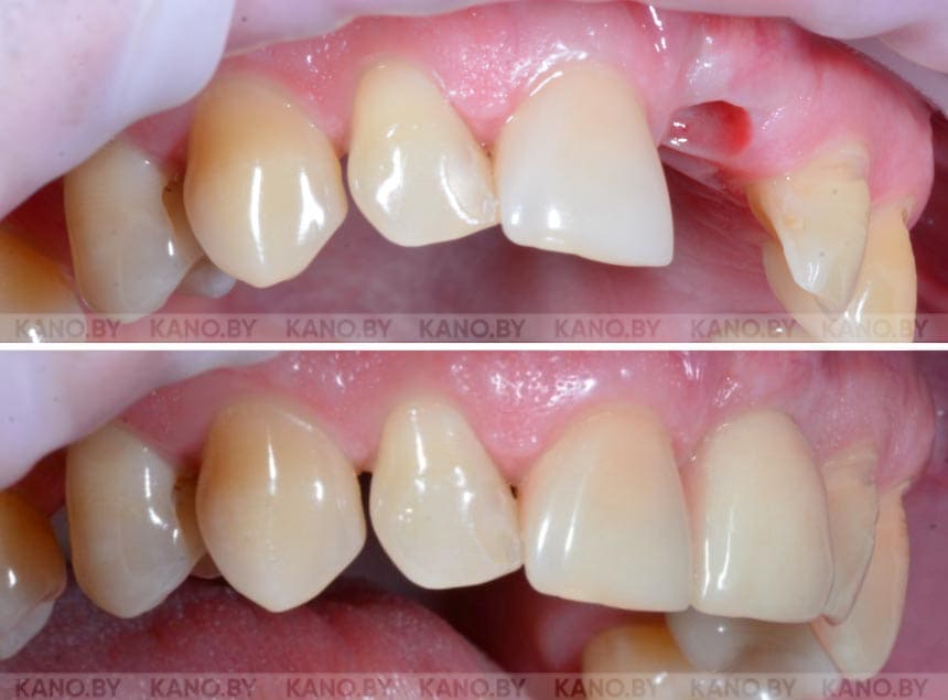 Ц.С. Кейс №78. Имплантация после травмы переднего зуба