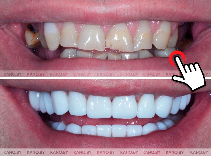 Ц.С. Кейс №7. Тотальное восстановление зубов E.max