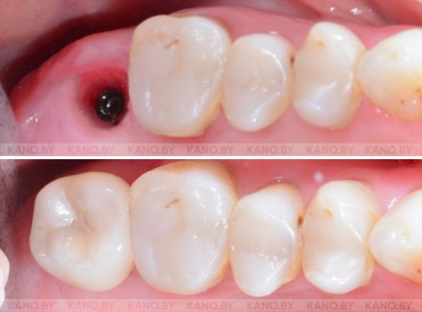 Ц.С. Кейс №81. Коронка Cerec на имплант