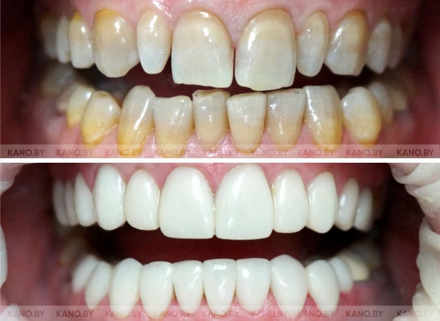 Что такое «тетрациклиновые» зубы? (такие, как на верхнем фото) Тетрациклино | Instagram