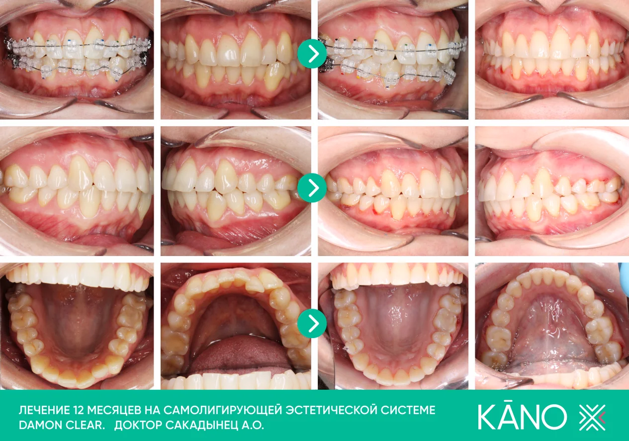 ortodontiyakeisiobshchie4.webp